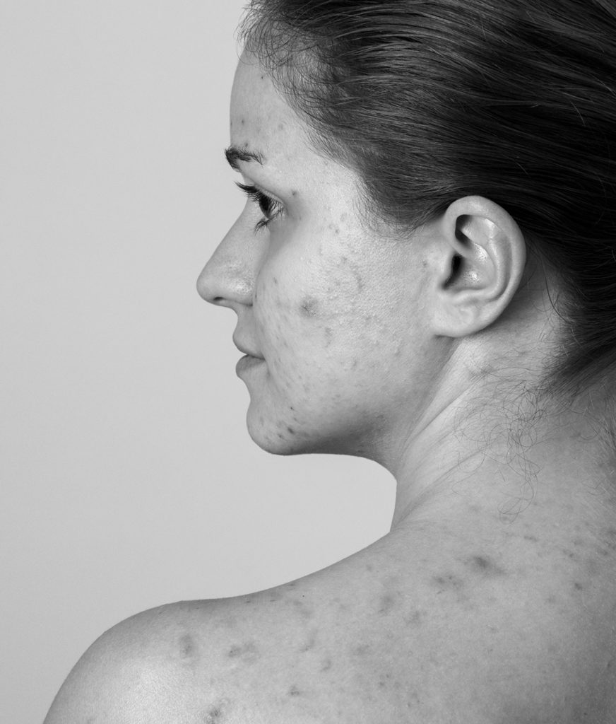 Woman with face and back acne