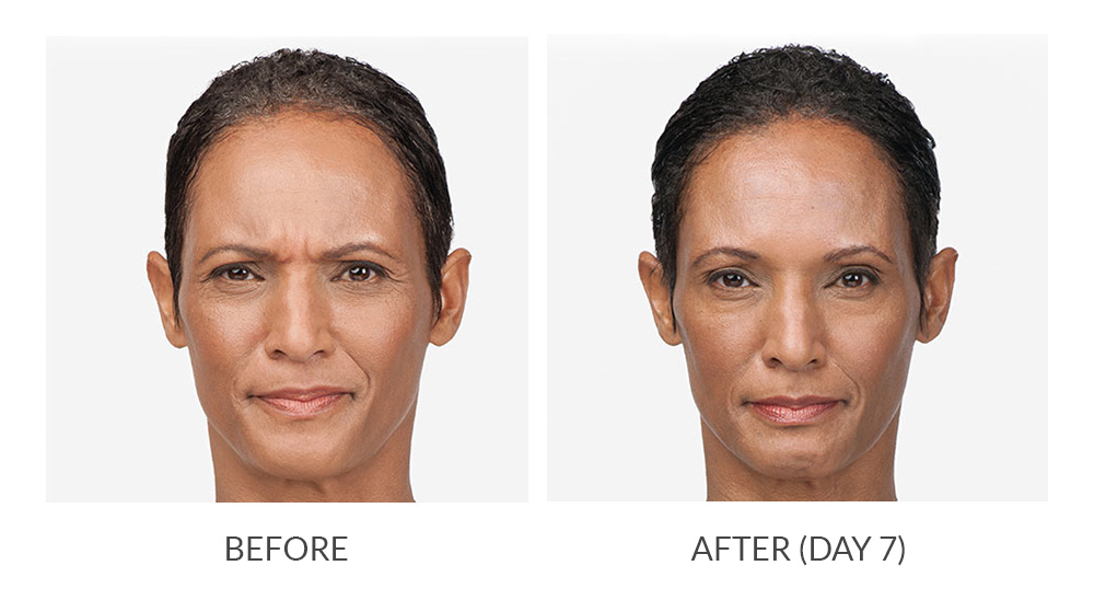 Before and after BOTOX results