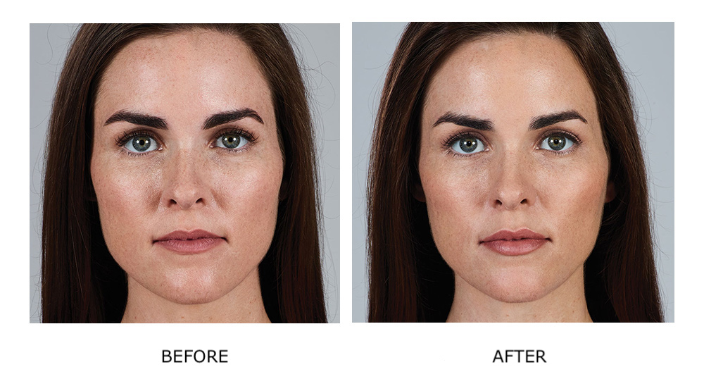 Before and after Juvéderm results