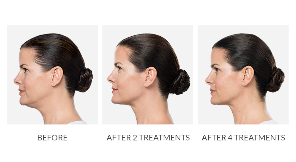 Before and after Kybella results