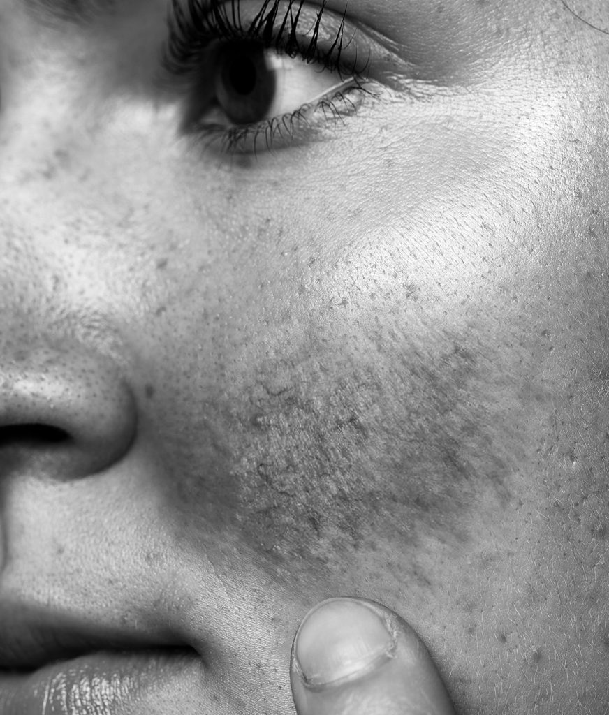 Close-up on a woman's cheek