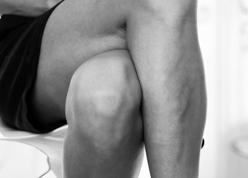 Varicose veins on a man's legs