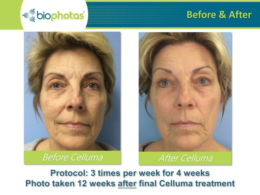 Before and after Celluma treatments