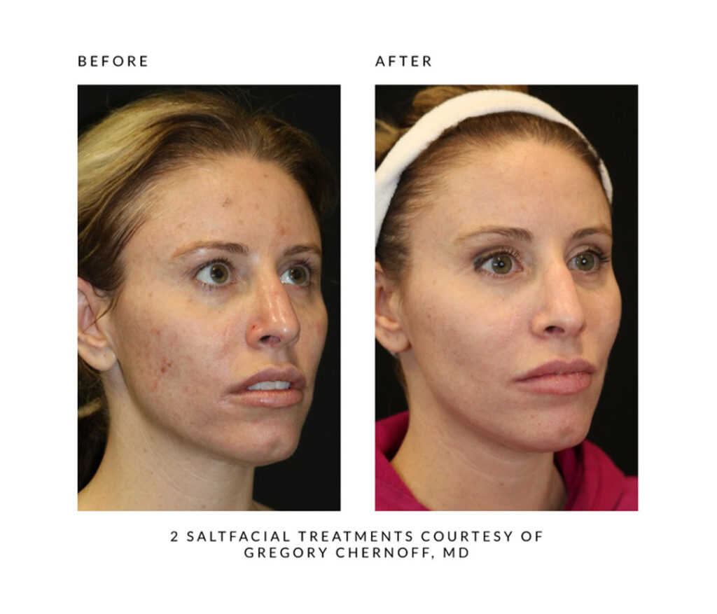 Before and after SaltFacial results