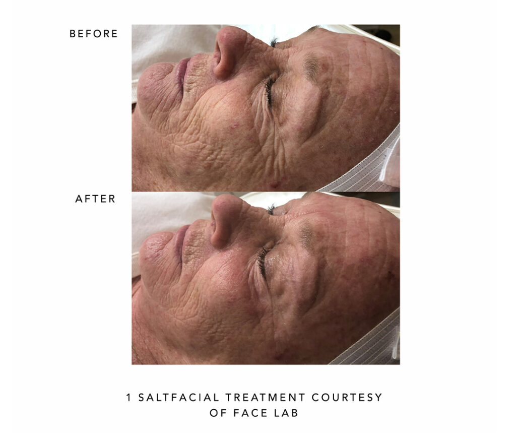 Before and after SaltFacial results