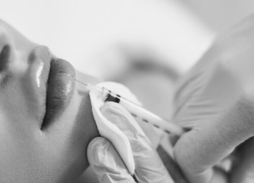Photo of a woman getting lip fillers