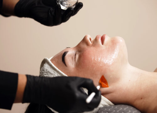 Chemical Peel Lindenhurst NY: Benefits, Results & Is It Worth It?
