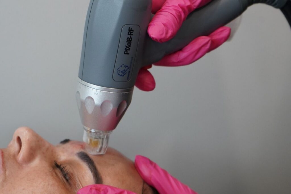 RF Microneedling stimulates collagen to tighten and improve skin texture Long Island NY