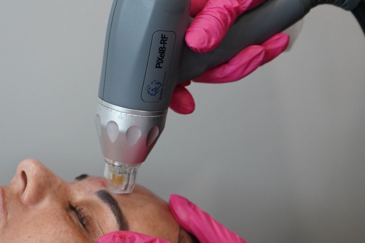 RF Microneedling vs. Classic Microneedling: Which One Is Right for You?